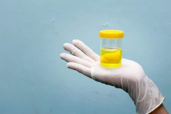 Urinprobe